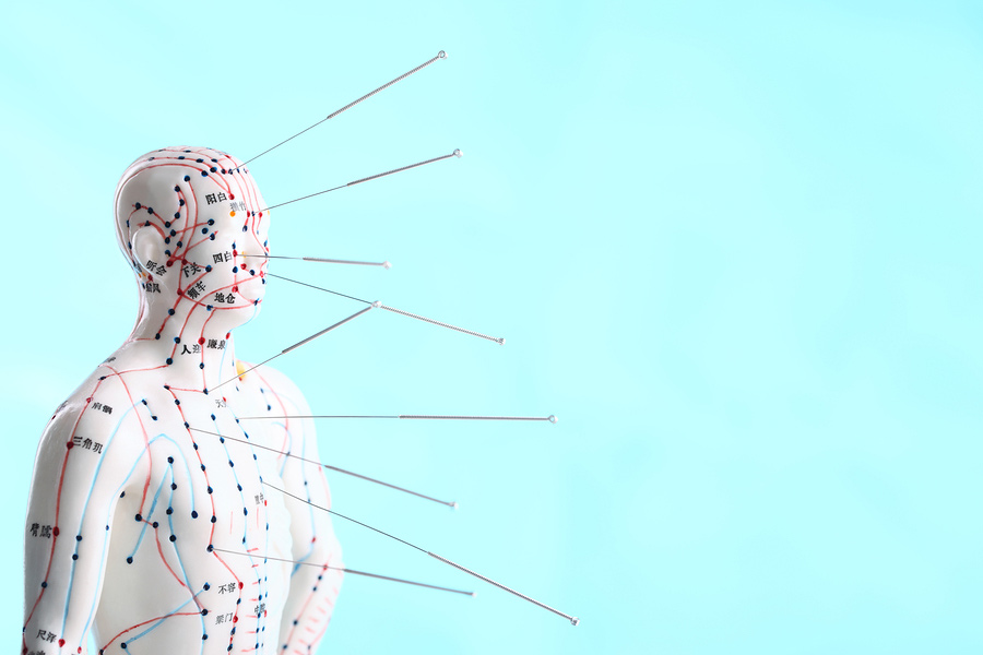 Acupuncture for Car Accident Injuries | Danbury, CT Chiropractor